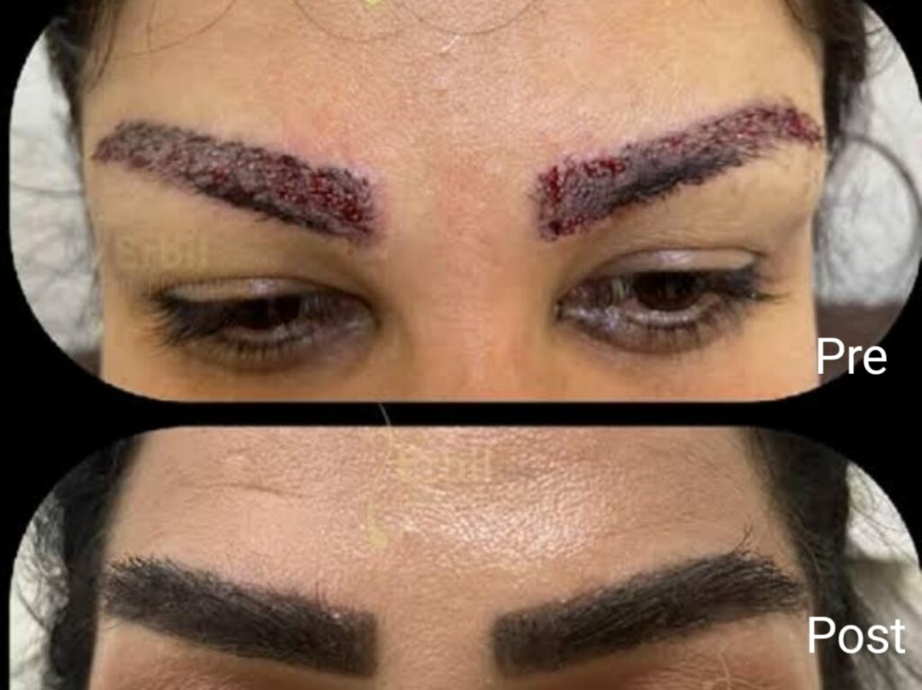 نتائج زراعة الحواجب قبل وبعد